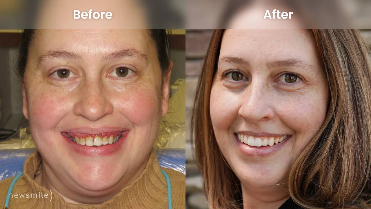 Middle-aged woman smiling before and after full mouth dental implants at New Smile Columbus Dental Implant Studio.
