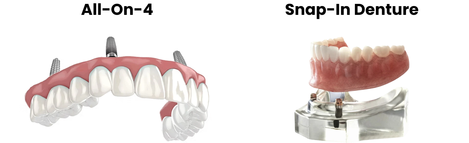 Side-by-side comparison of All On 4 vs Snap In Dentures.