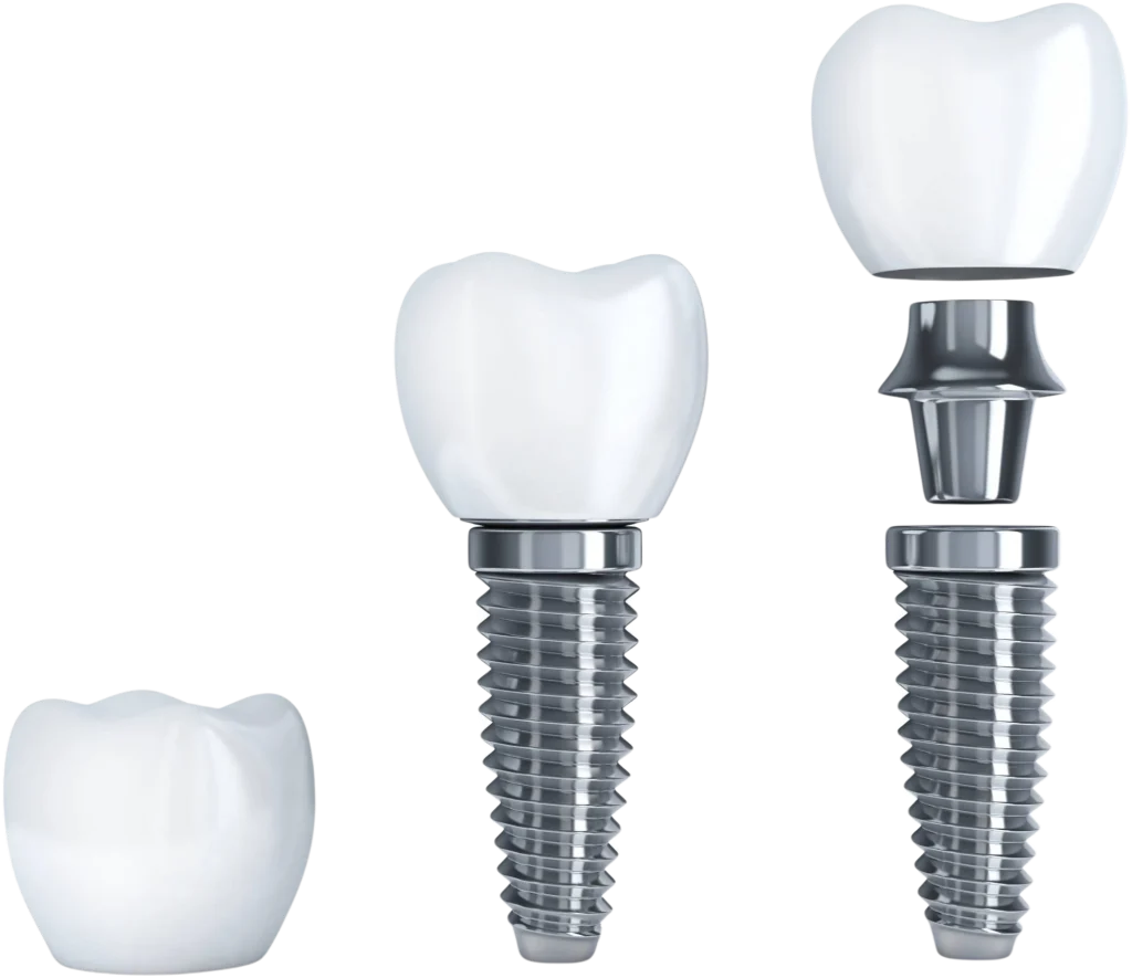 Model of a single tooth dental implant showing the implant body, abutment, and tooth crown