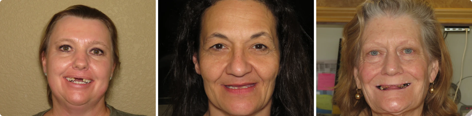 Photos of 3 patients with failing and missing teeth who are candidates for full mouth dental implants.