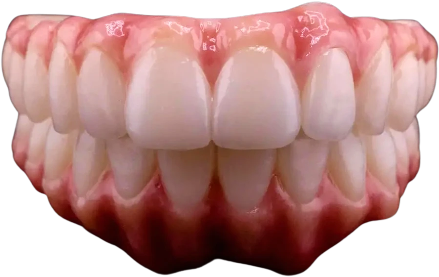 Image of final zirconia teeth - the last step in the full mouth dental implants process
