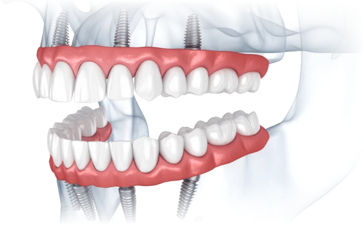 Graphic illustrating the all on 4 dental implants system for full mouth dental implants.