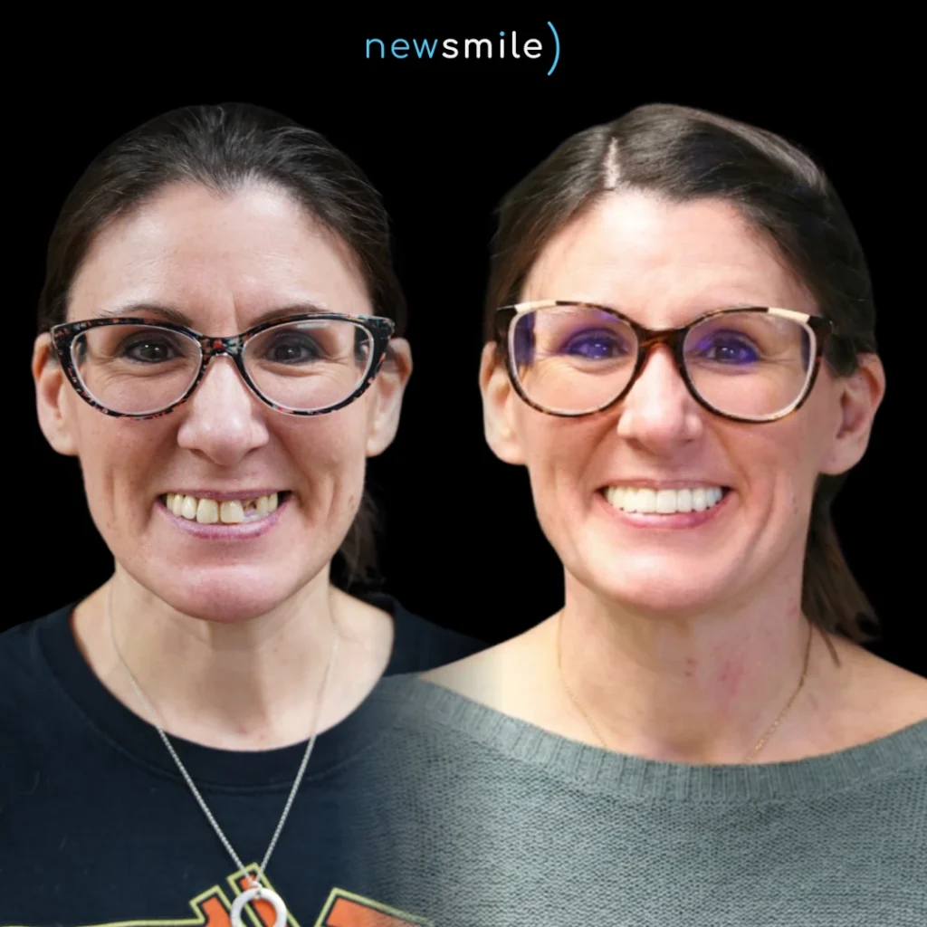 Before and after dental implants in Columbus, Ohio at New Smile Columbus Dental Implant Studio