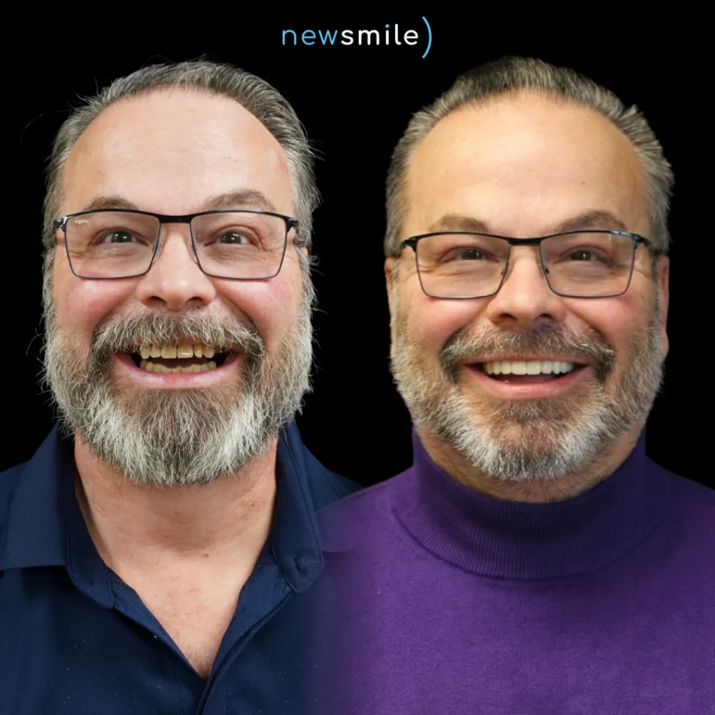 Before and after dental implants in Columbus, Ohio at New Smile Columbus Dental Implant Studio