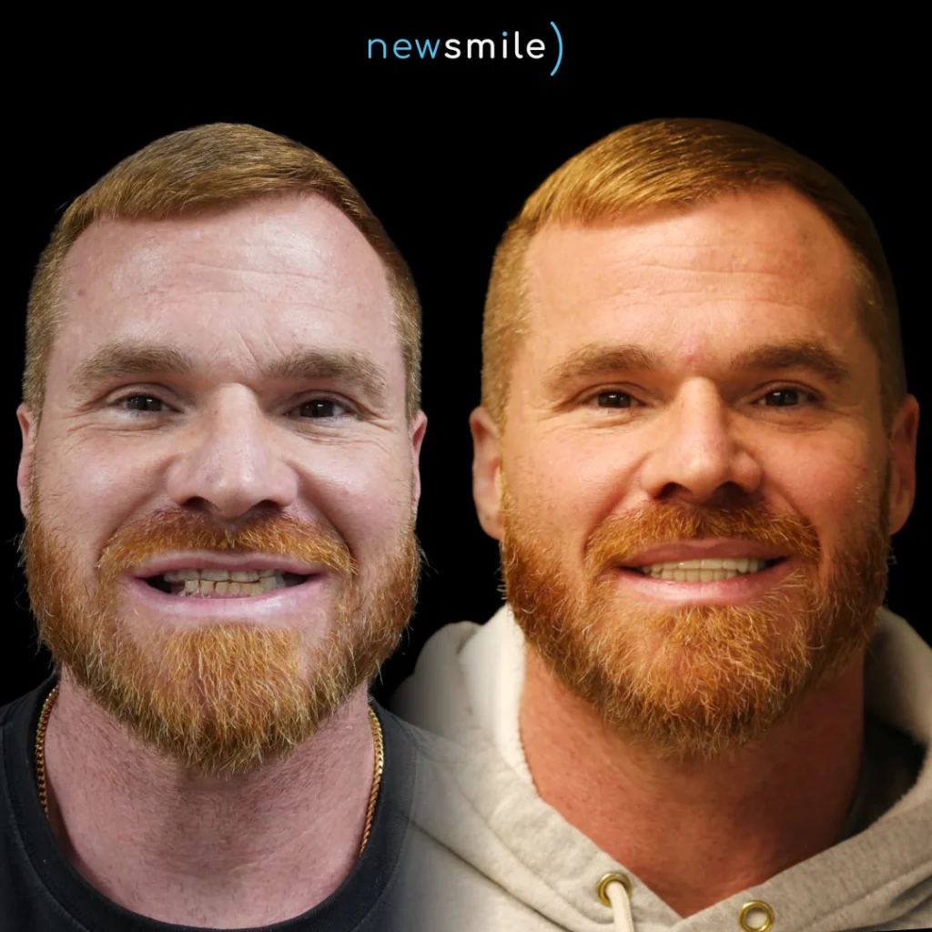 Before and after dental implants in Columbus, Ohio at New Smile Columbus Dental Implant Studio