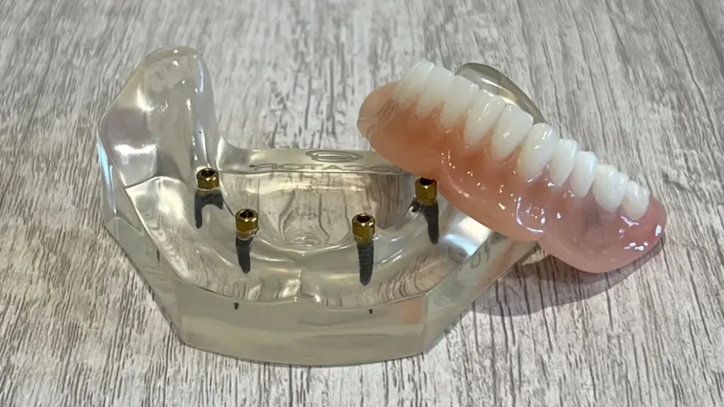 Implant-supported overdentures